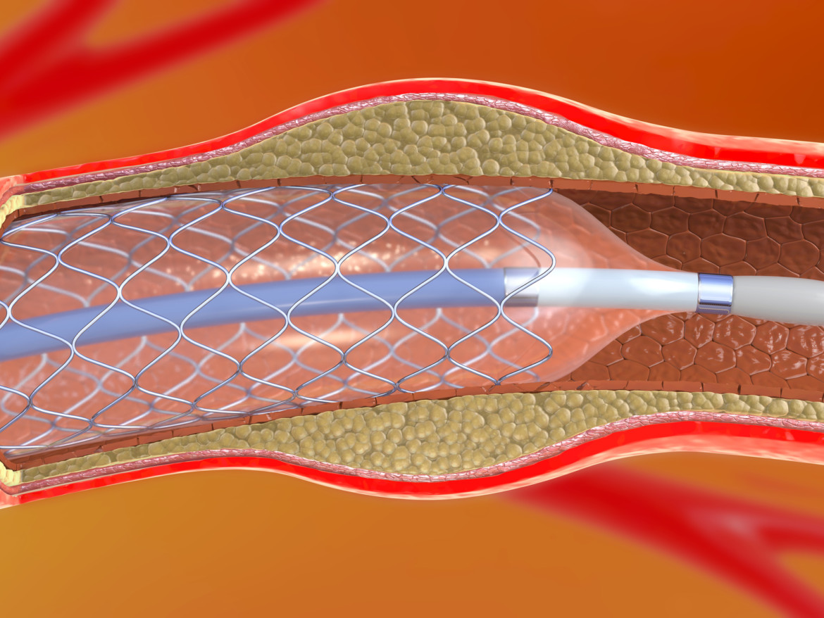 Bei einem großen Aneurysma besteht die Gefahr, dass es reißt. Ein Stent in der Arterie beugt vor.